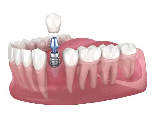 Implantat med krone