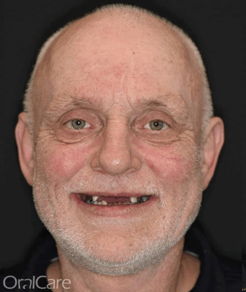 Simen før- og etter behandlingen hos OralCare