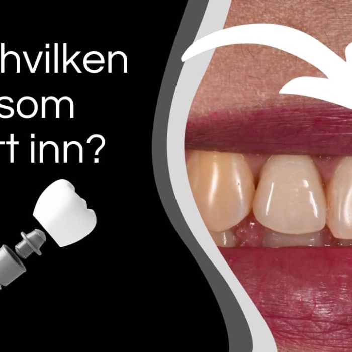 Fra knekt til perfekt: Kan du se hvilken tann som er krone her?