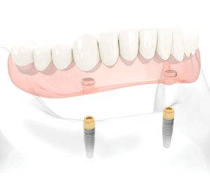 Protese på implantat for underkjeve