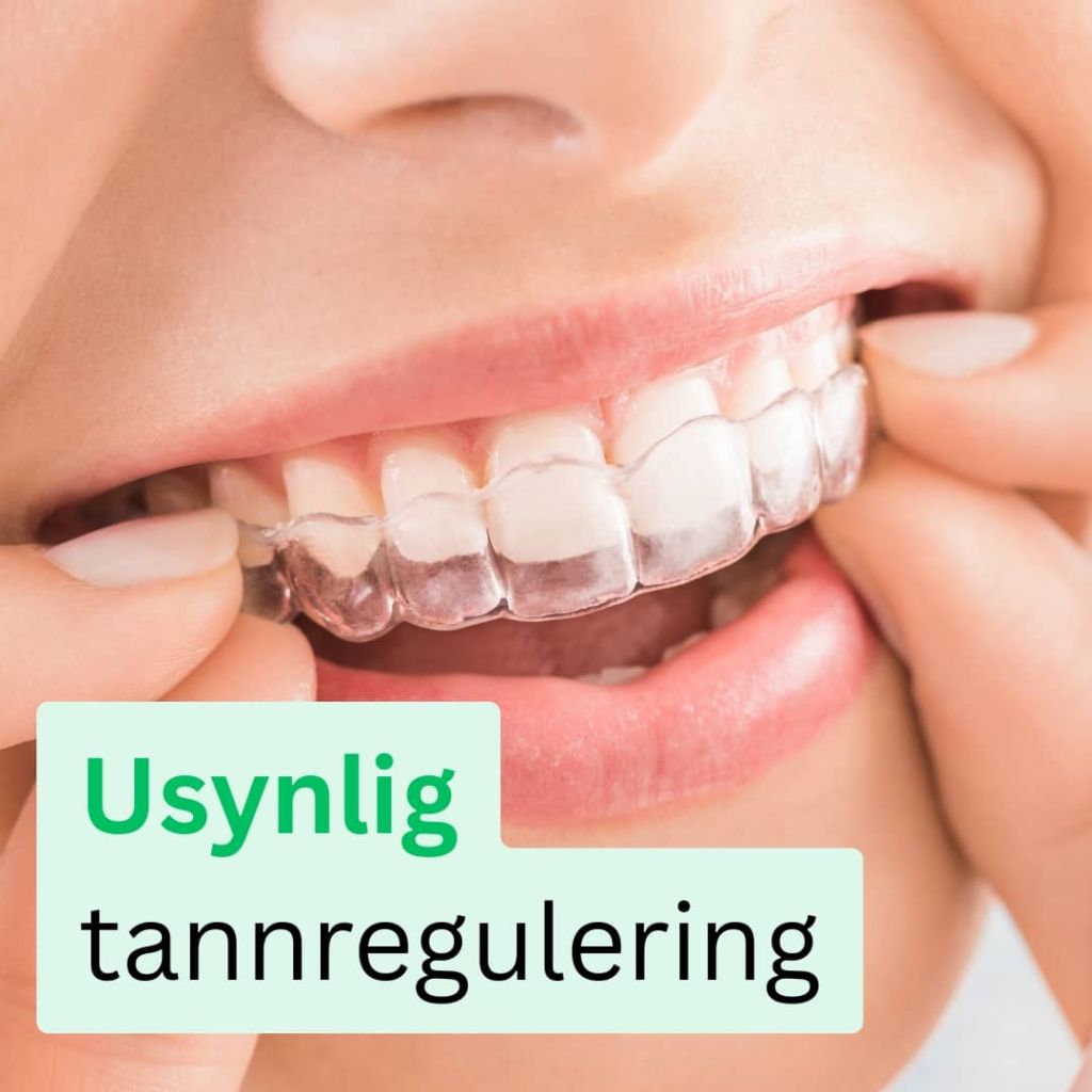 Usynlig tannregulering