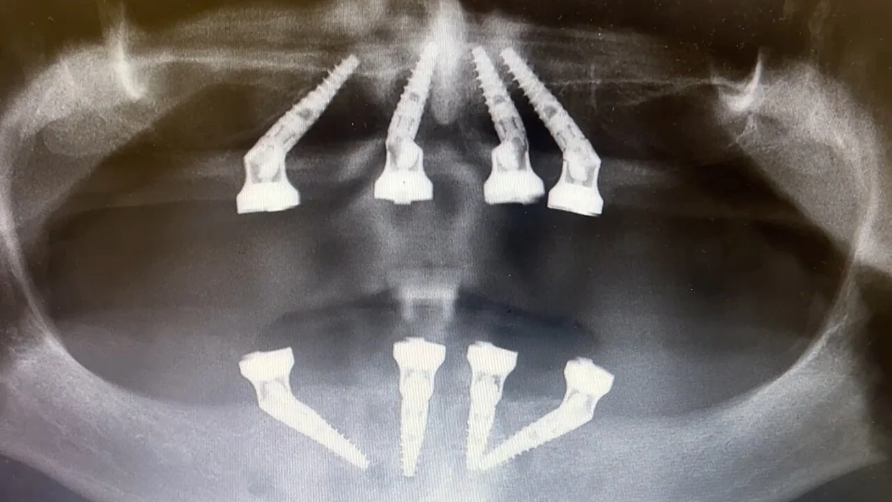 Røntgenbildet etter tannimplantat ble satt inn