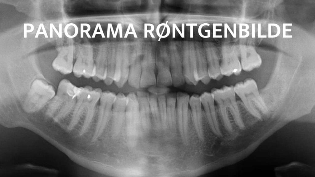 OPG panorama røntgenbilde