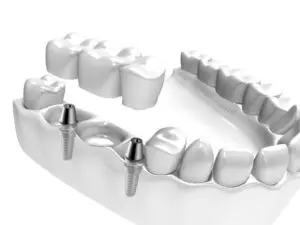 Tre manglende tenner kan erstattes med to implantat og bro