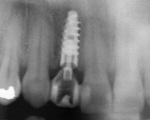 Implantat satt inn - Tannen ble trukket og implantat ble satt inn på samme timeavtale.