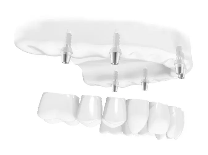 Erstatt flere manglende tenner med implantat