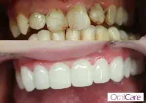 for-etter-tannbehandling5