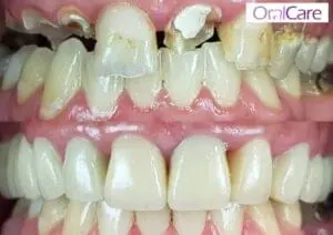 for-etter-tannbehandling6