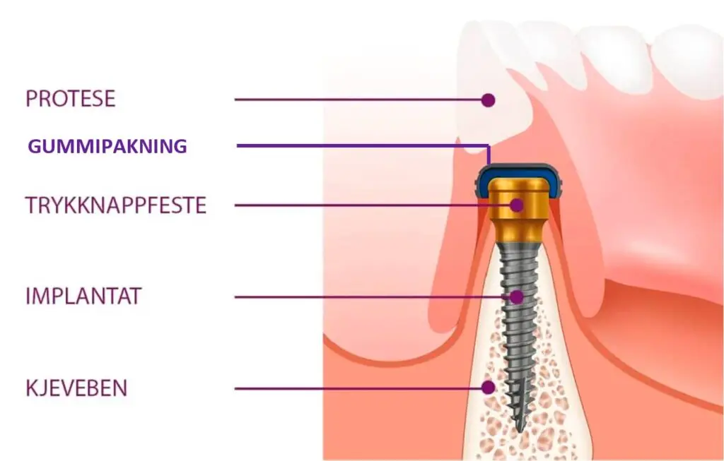 Klikkprotese på tannimplantat i underkjeve