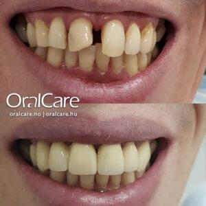 kronerbro-oralcare-overkjeve2