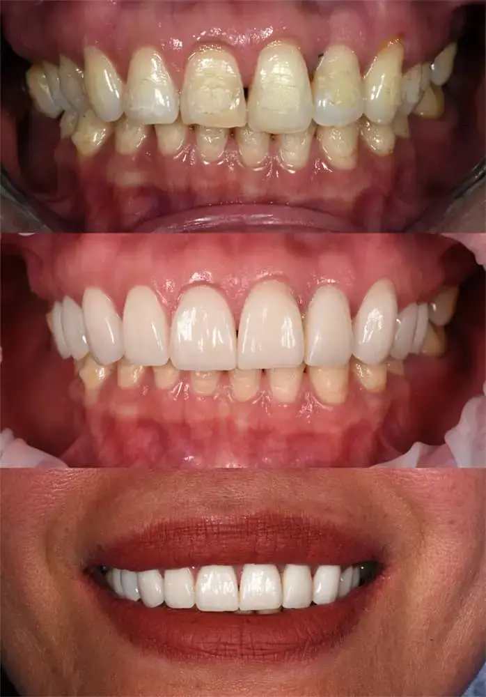 Skallfasetter på tenner i overkjeve. Behandling utført av tannlege Adrian Matic. Ingen behandling i underkjeven.