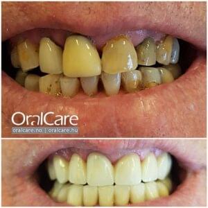 tannbro-underkjeve-overkjeve-oralcare