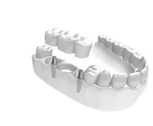 Erstatt tre eller flere manglende tenner med implantat