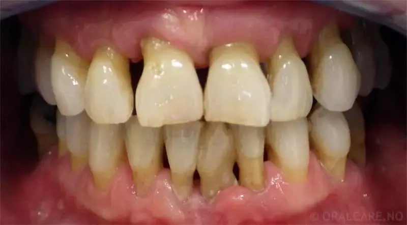 Foto av tenner der tannkjøtt har trukket seg tilbake grunnet bentap.